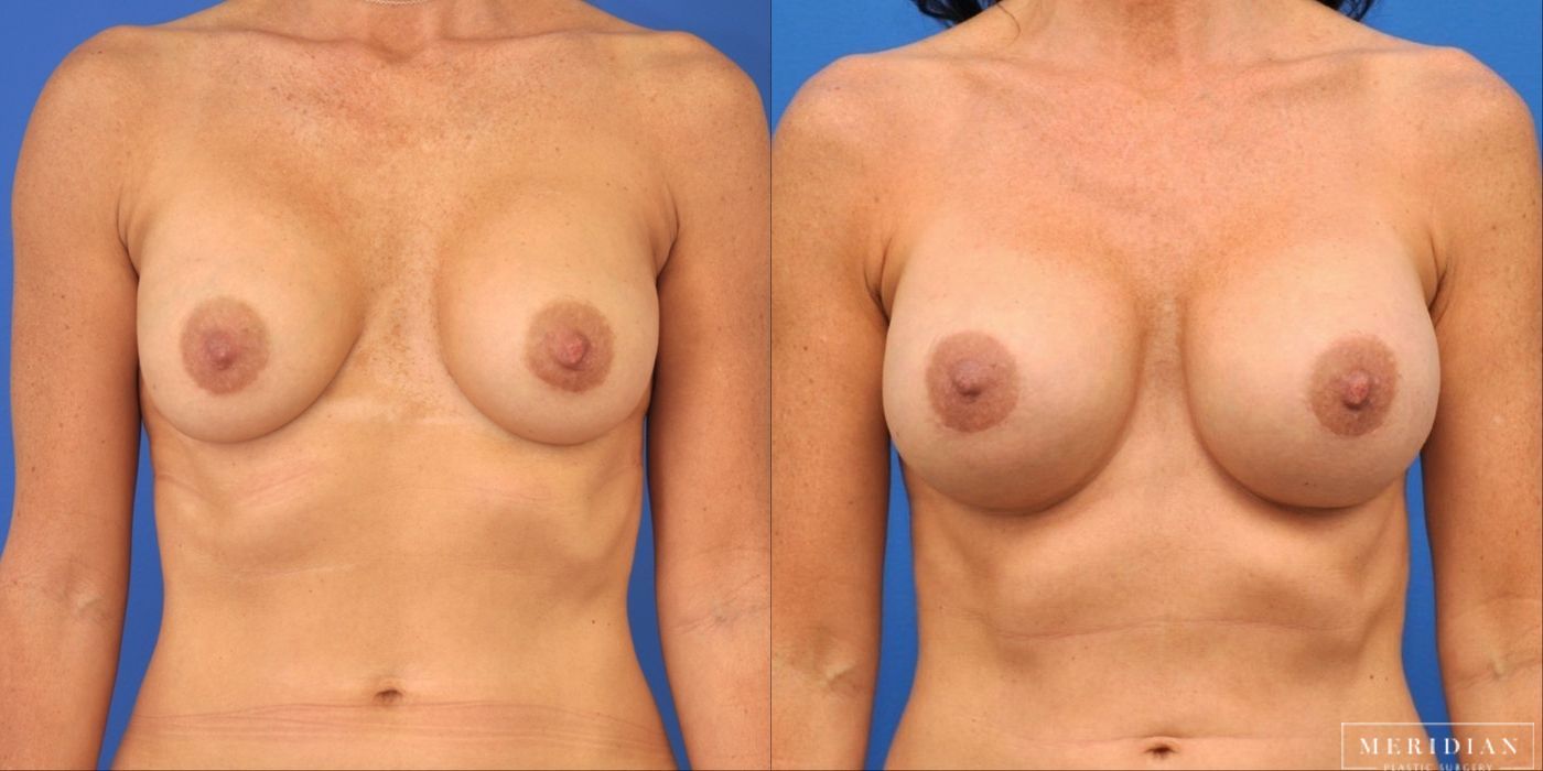 Breast Revision - Case 8567