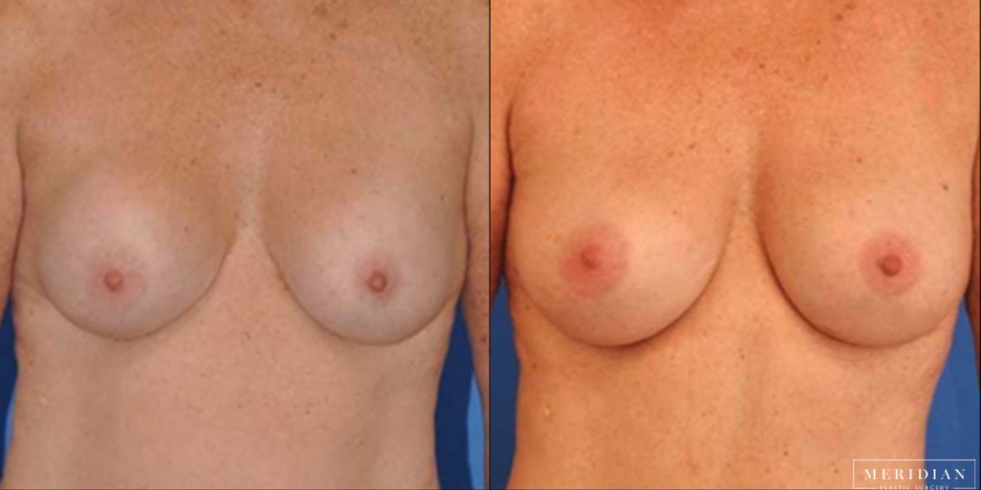 Breast Revision - Case 8576