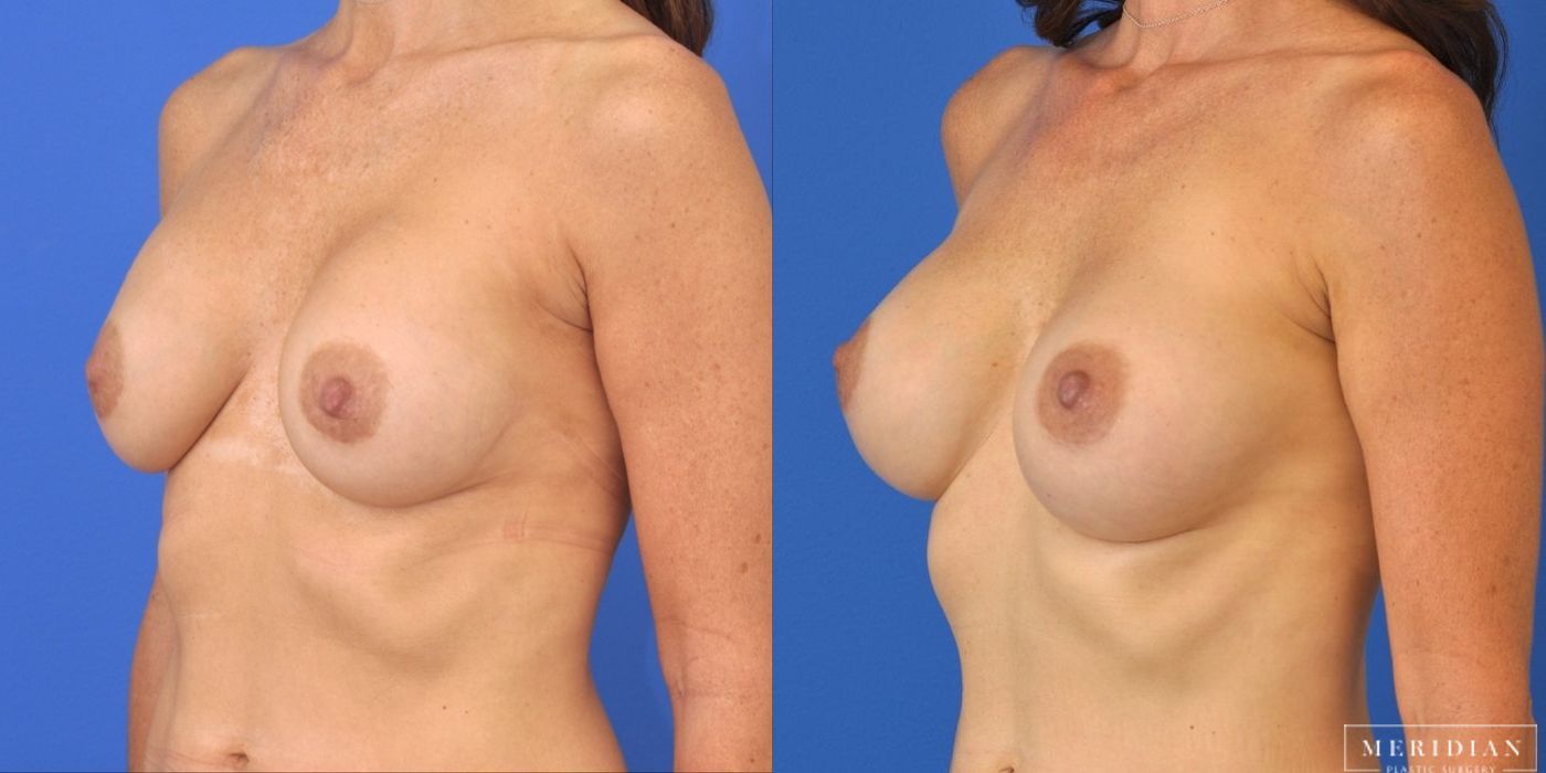 Breast Revision - Thumbnail 4