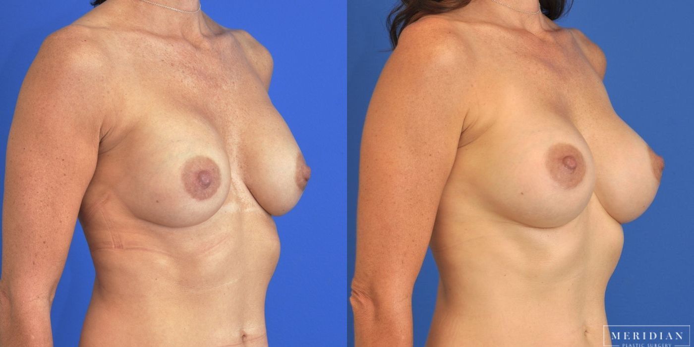 Breast Revision - Thumbnail 2