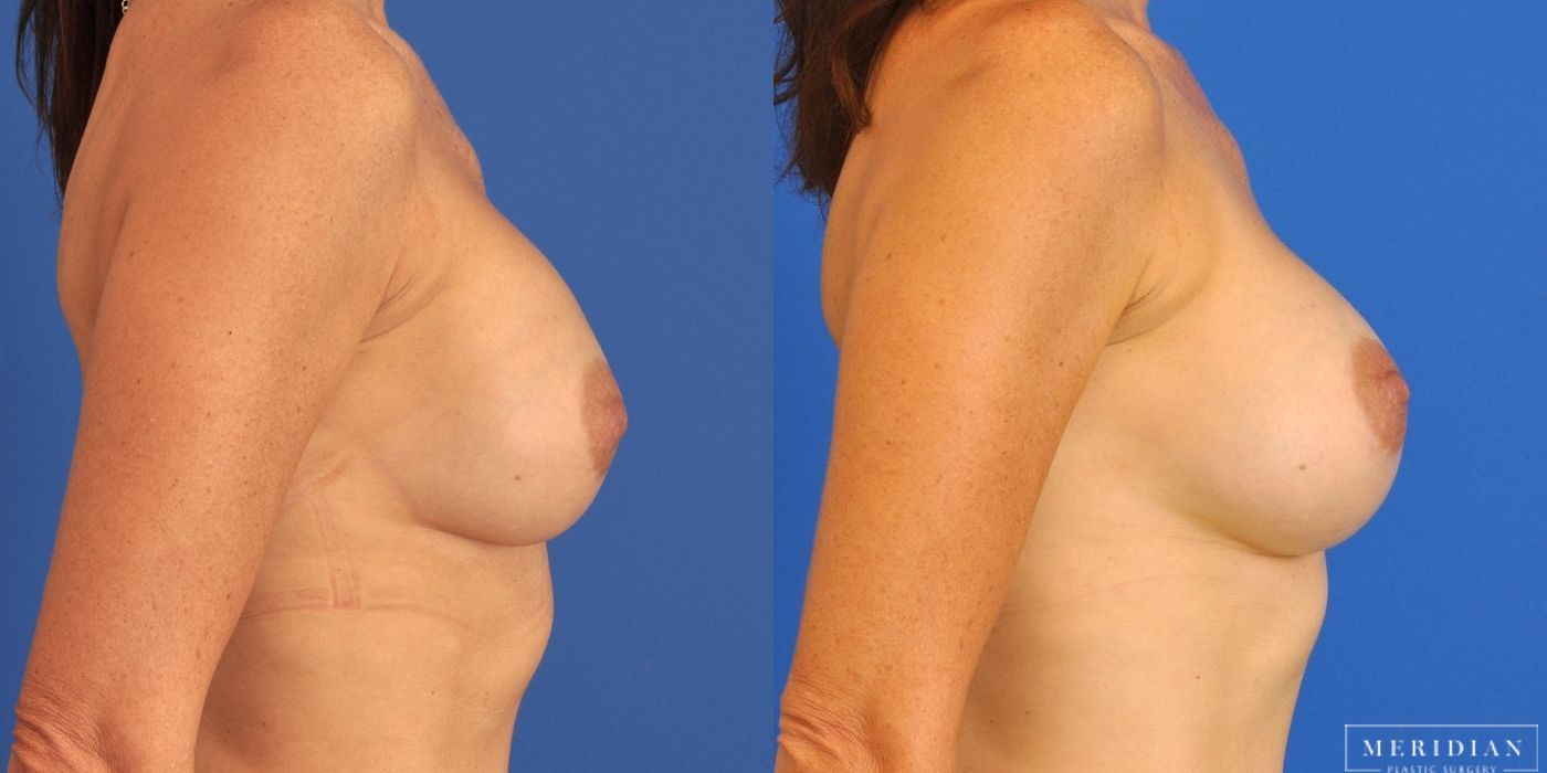 Breast Revision - Thumbnail 2