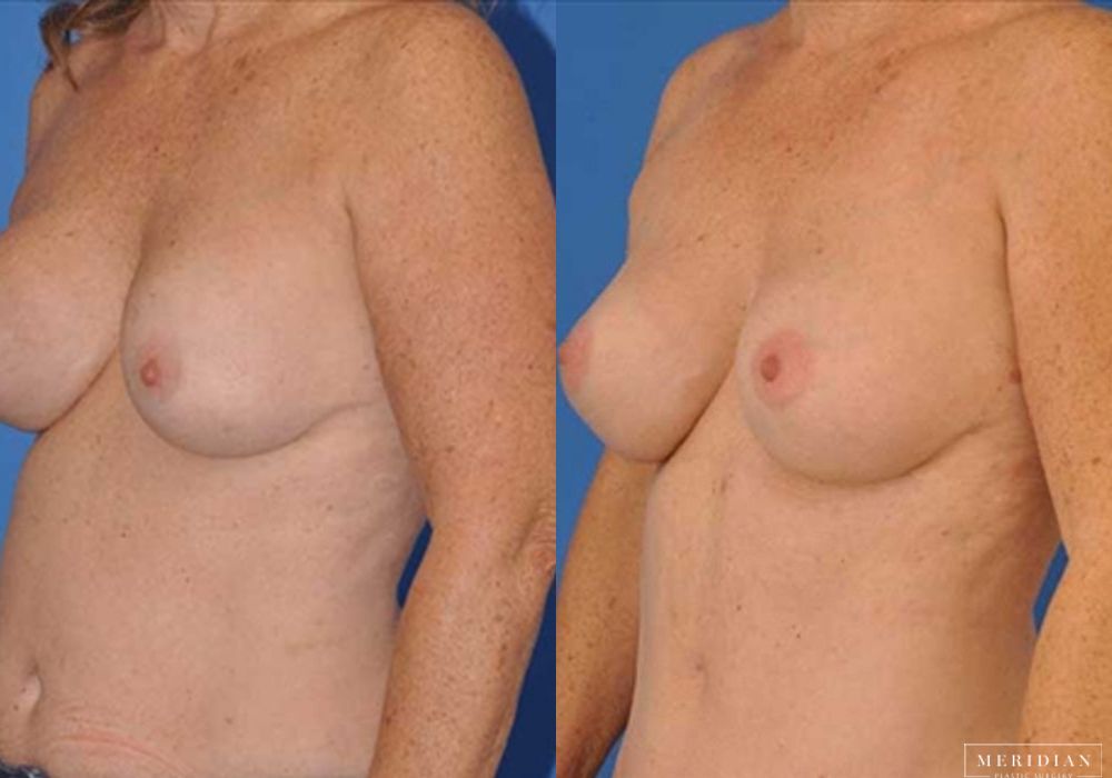 Breast Revision - Thumbnail 2