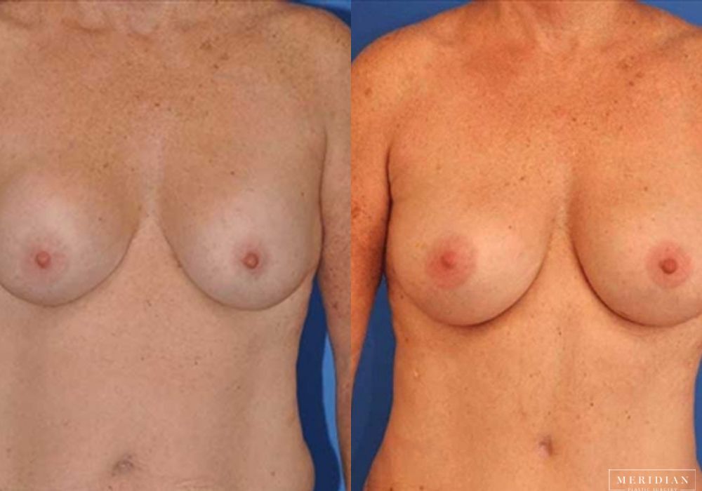 Breast Revision - Case 8083