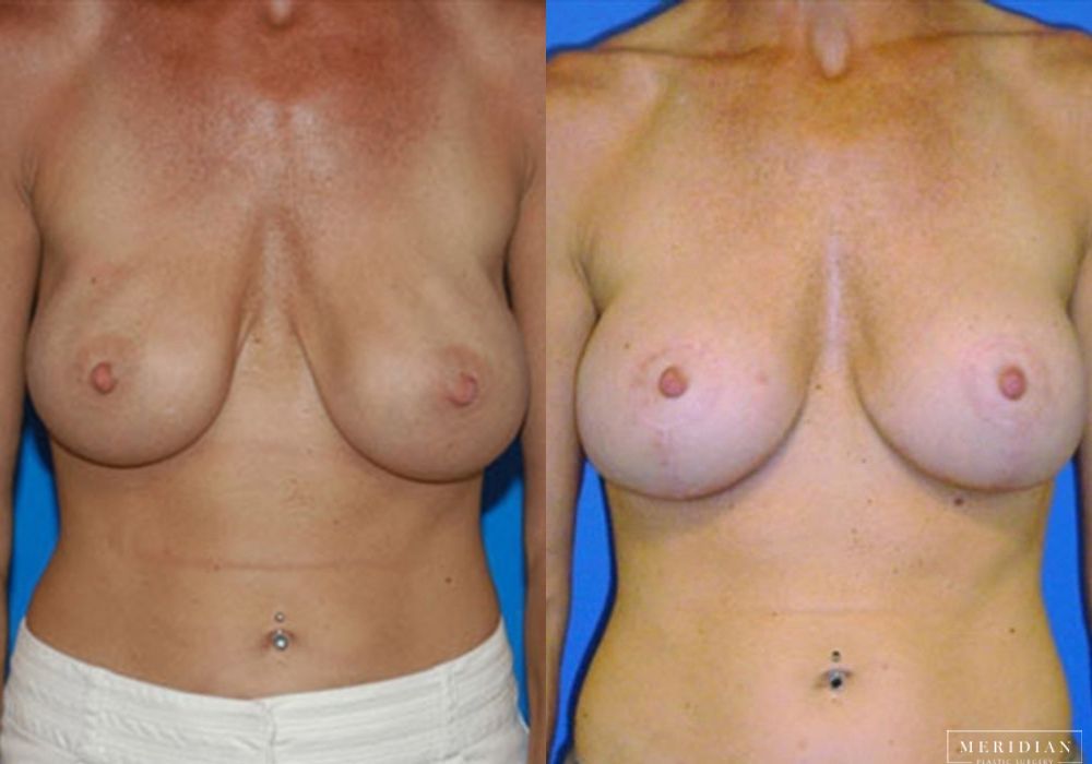 Before and after procedure result