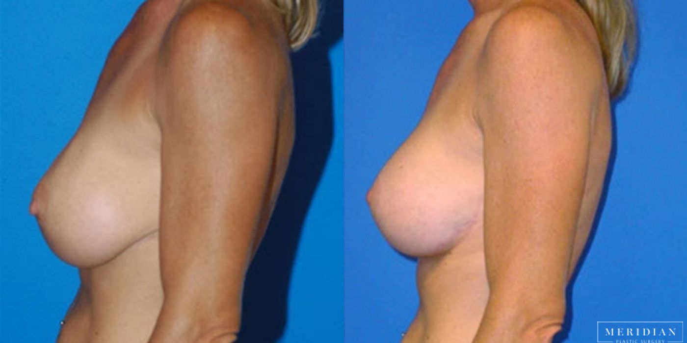 Breast Revision - Thumbnail 2