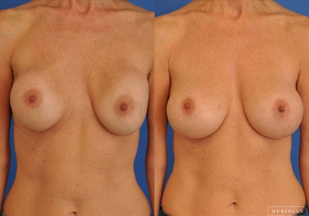 Before and after procedure result
