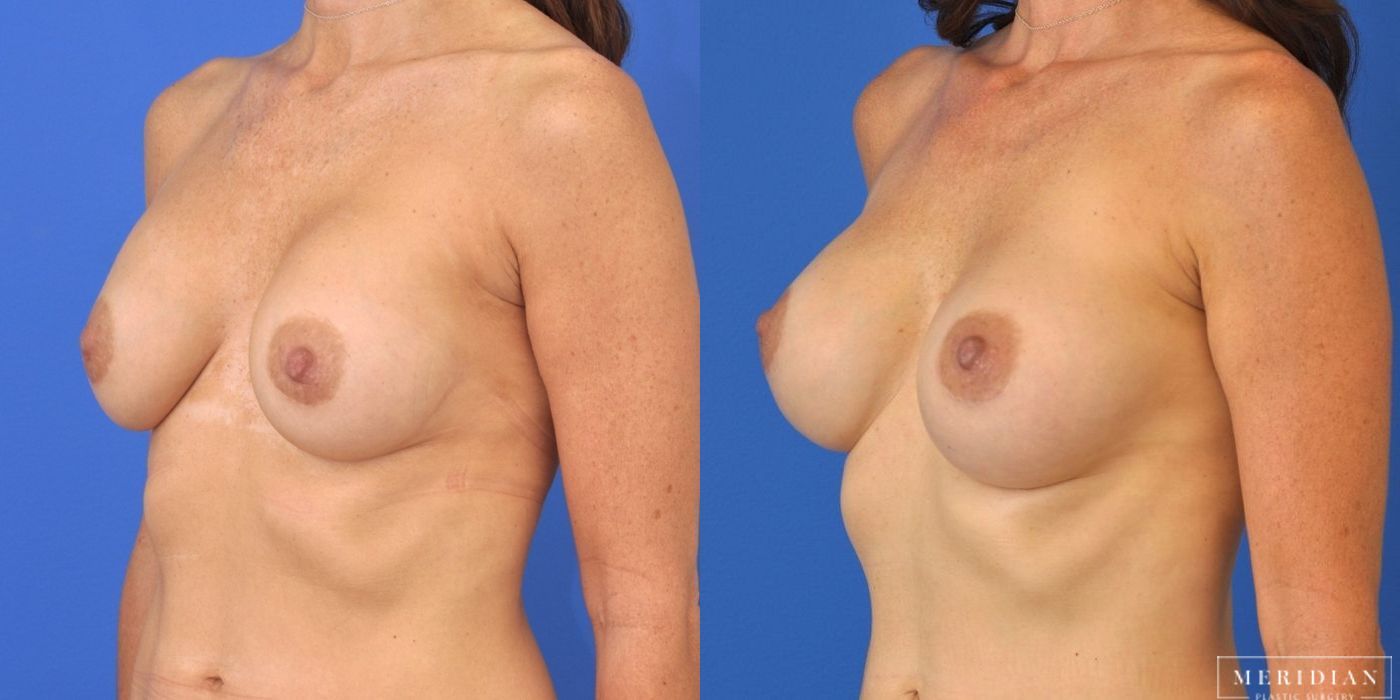 Breast Revision - Thumbnail 3
