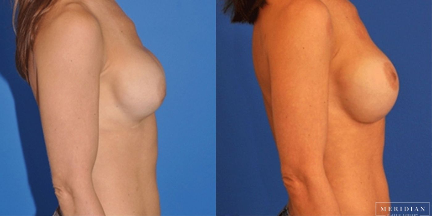 Breast Revision - Thumbnail 2