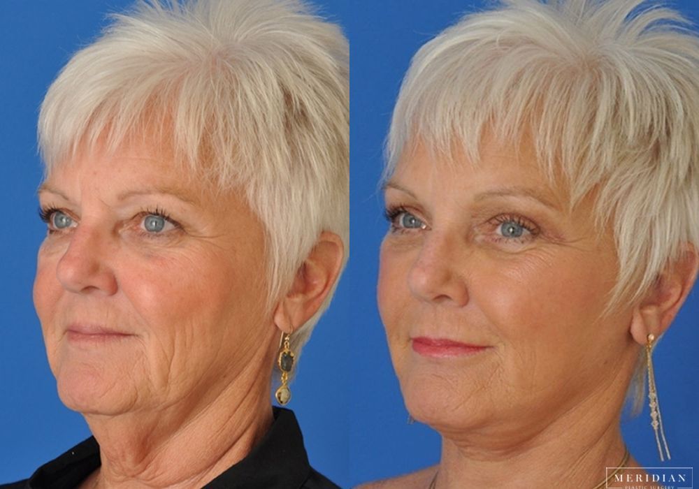 Brow Lift - Thumbnail 2