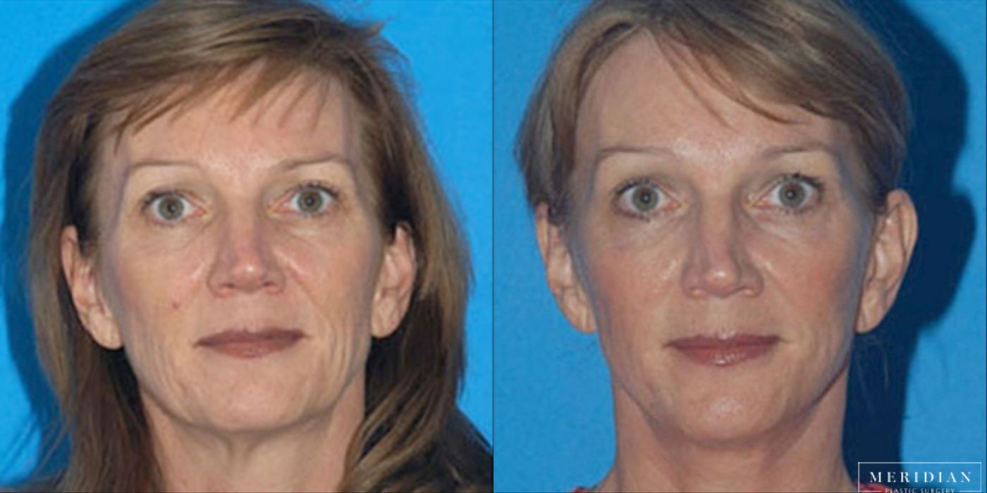 Brow Lift - Case 8593