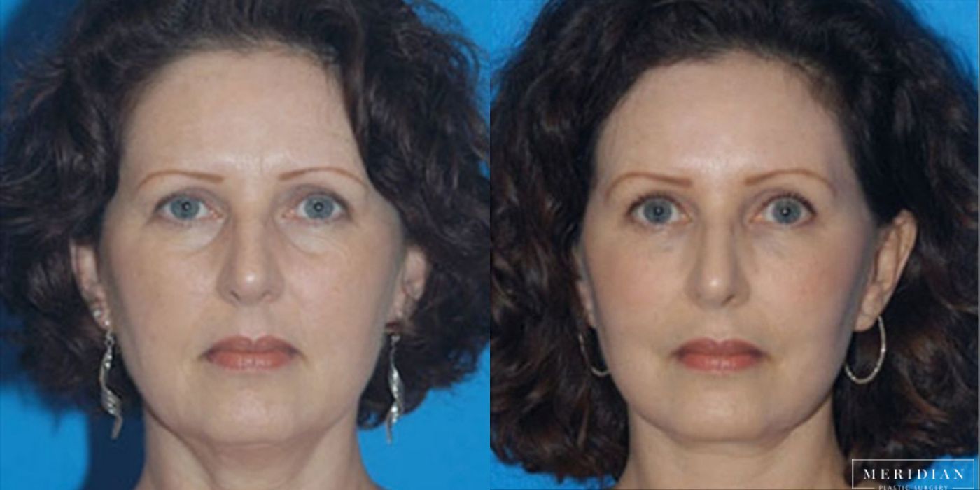 Brow Lift - Case 8592