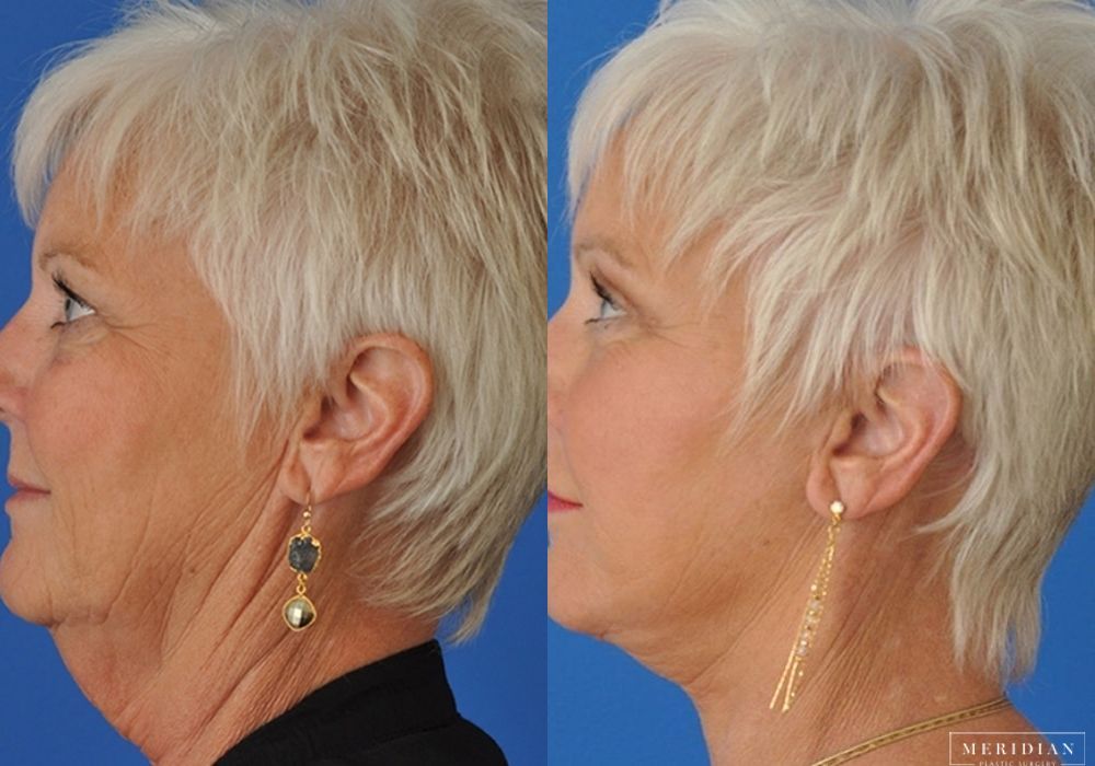 Brow Lift - Thumbnail 3