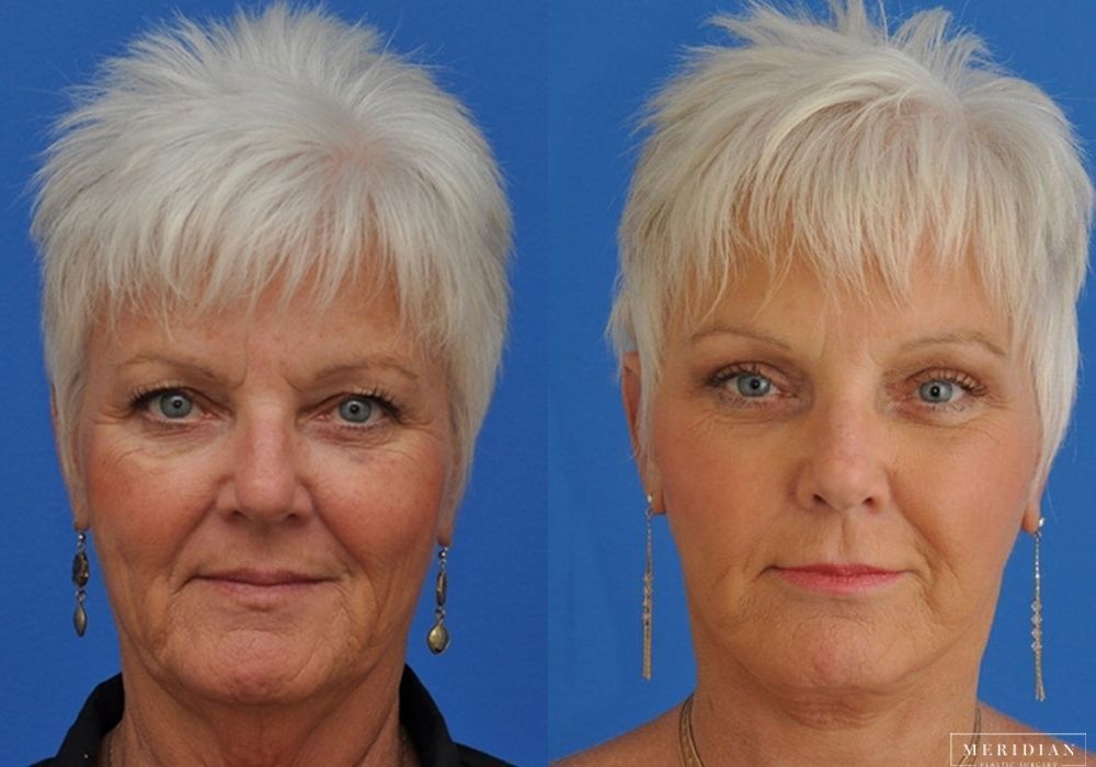 Brow Lift - Case 7916