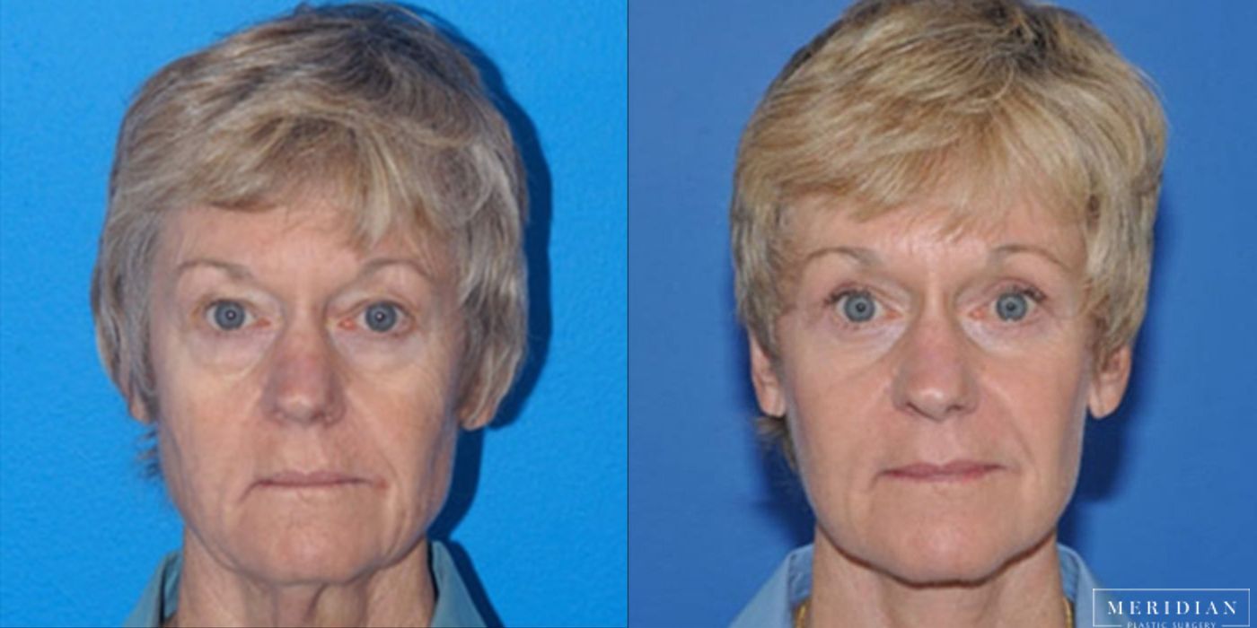 Brow Lift - Case 8590