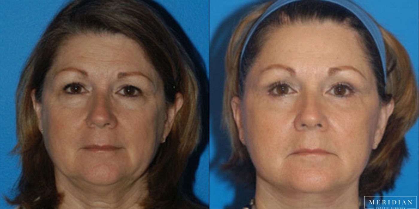 Brow Lift - Case 8589