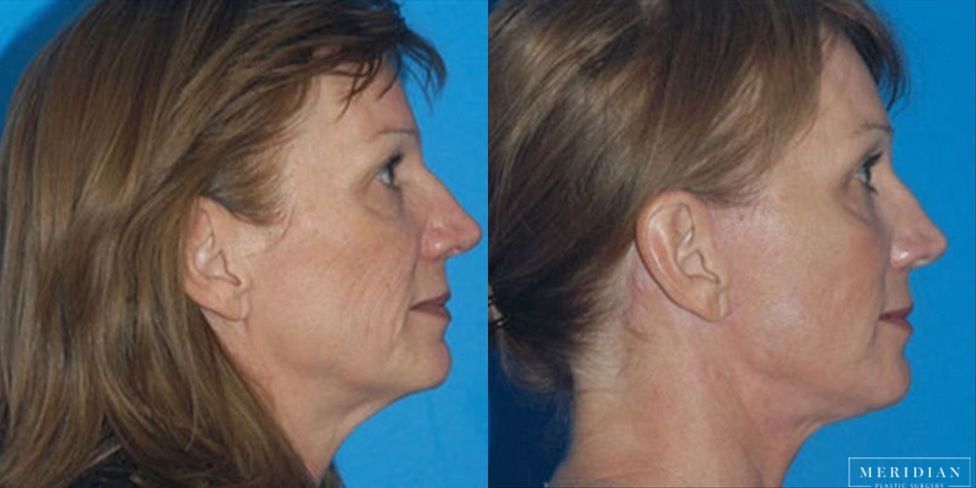 Brow Lift - Thumbnail 2