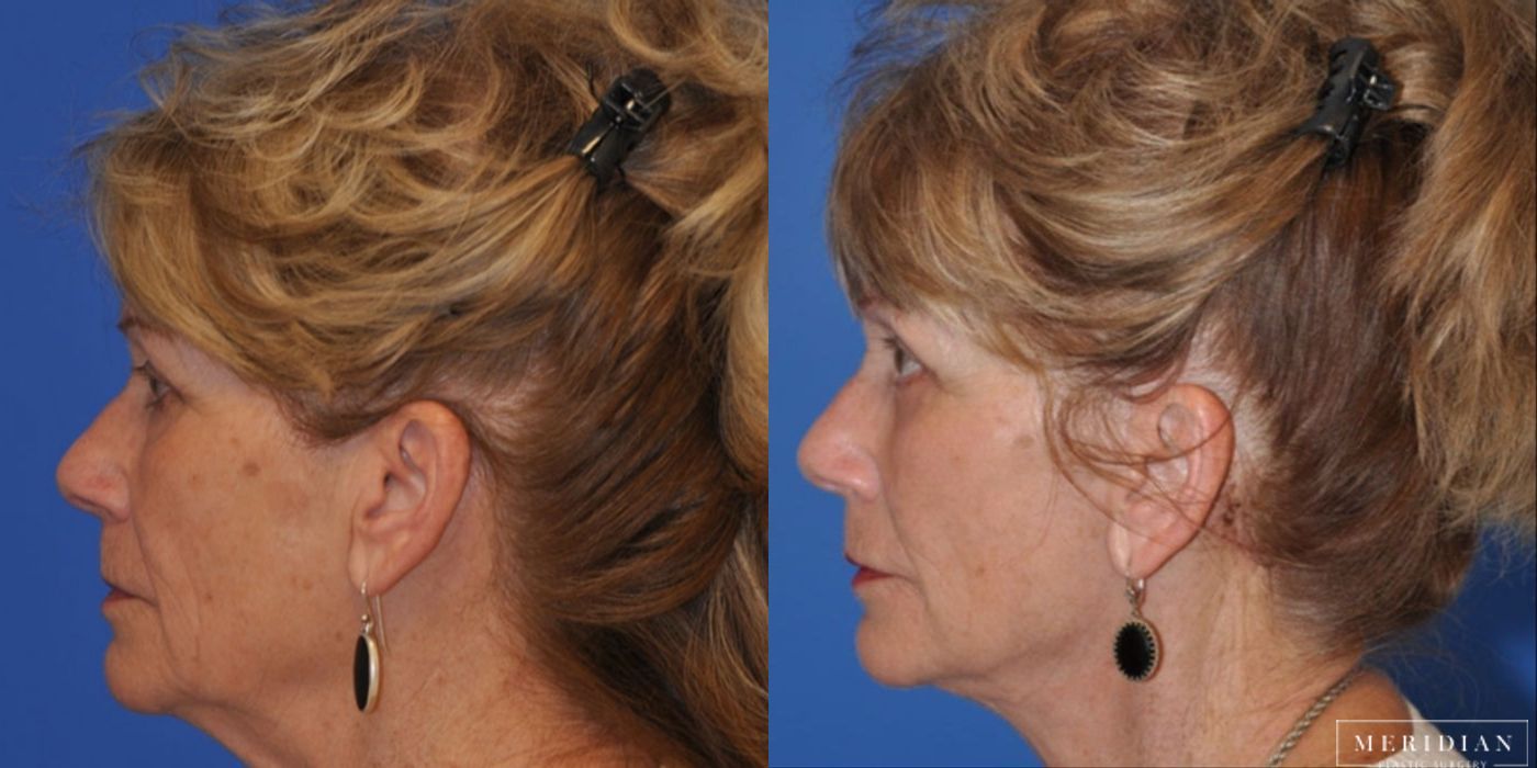 Brow Lift - Thumbnail 2