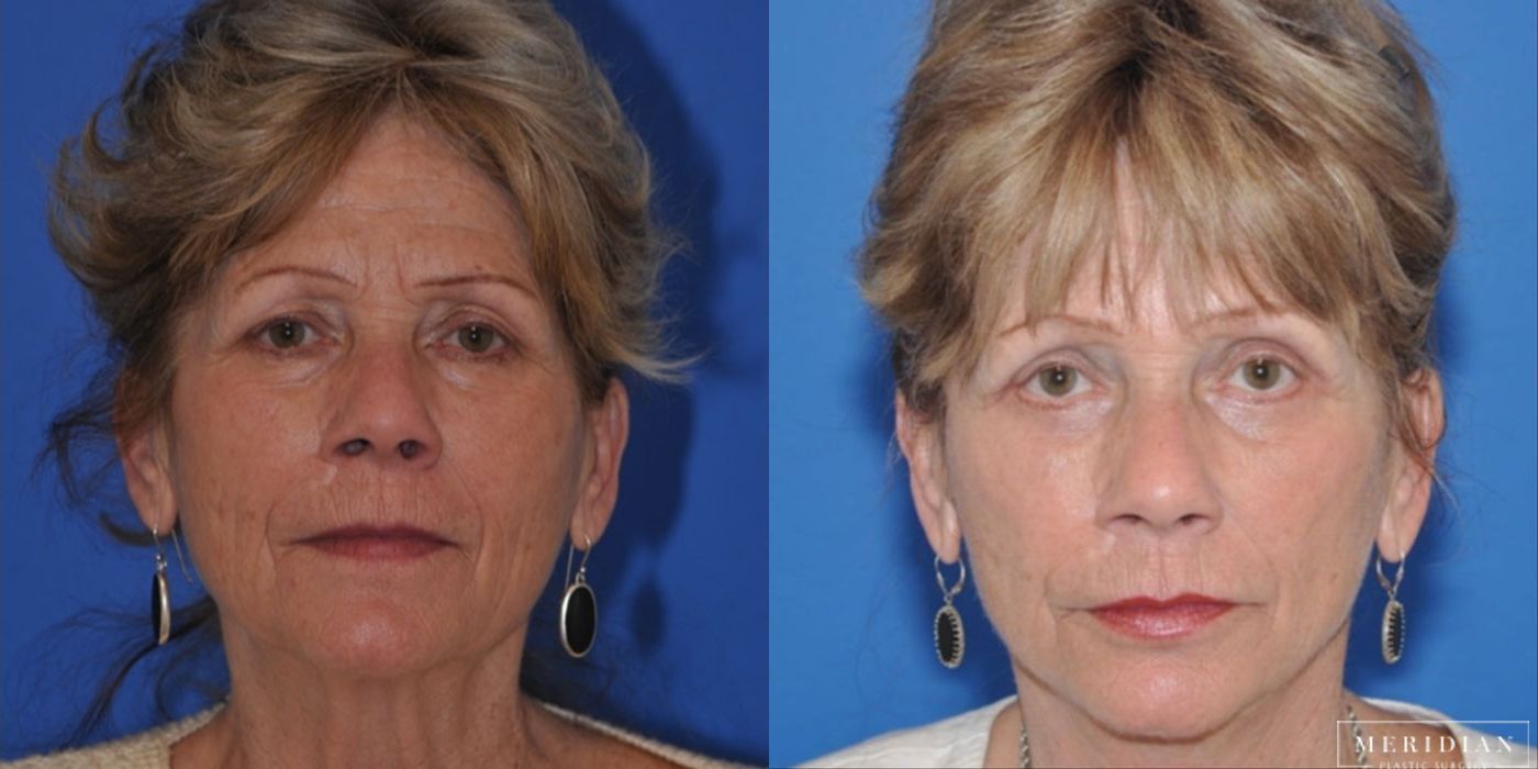 Brow Lift - Case 8594