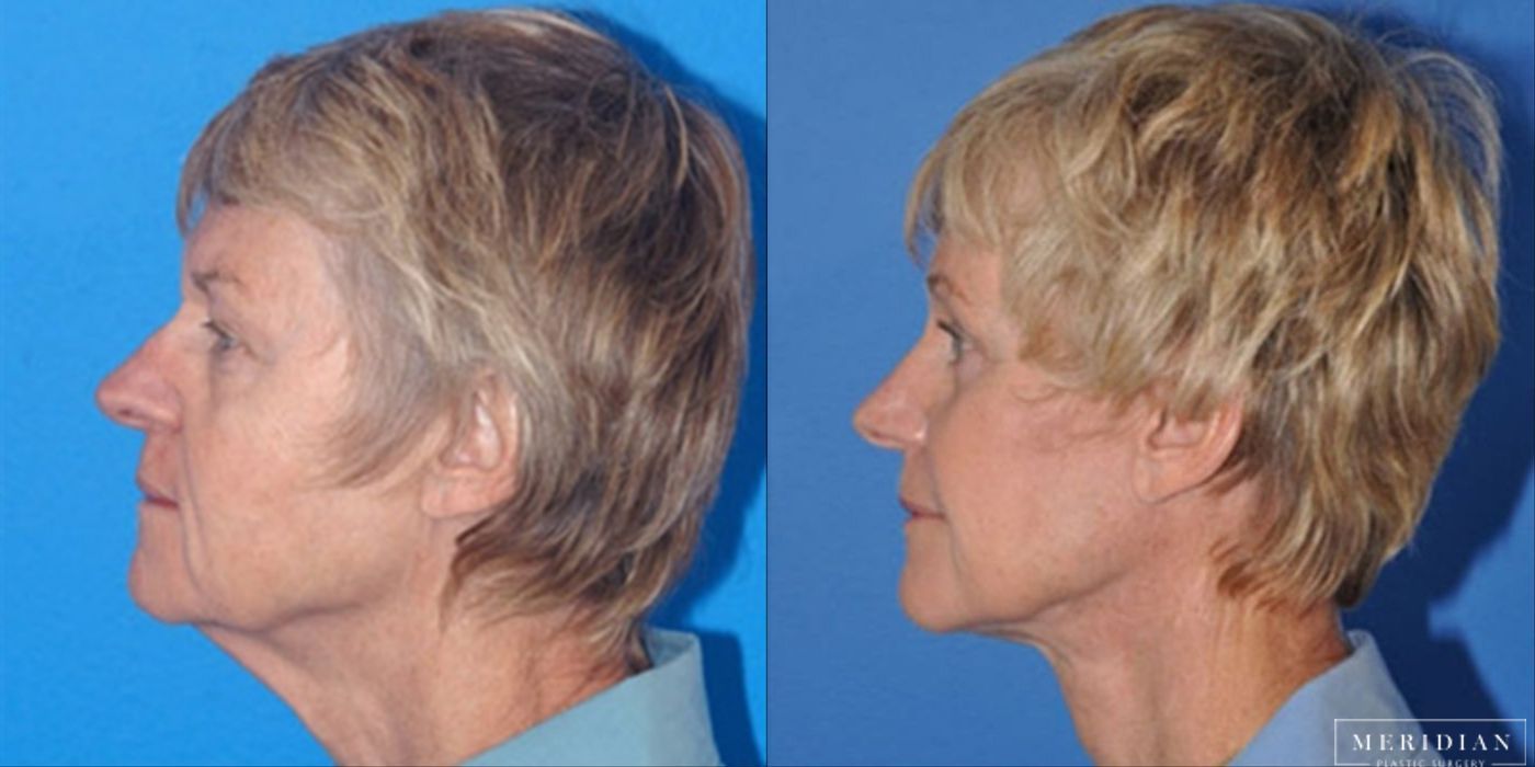 Brow Lift - Thumbnail 2