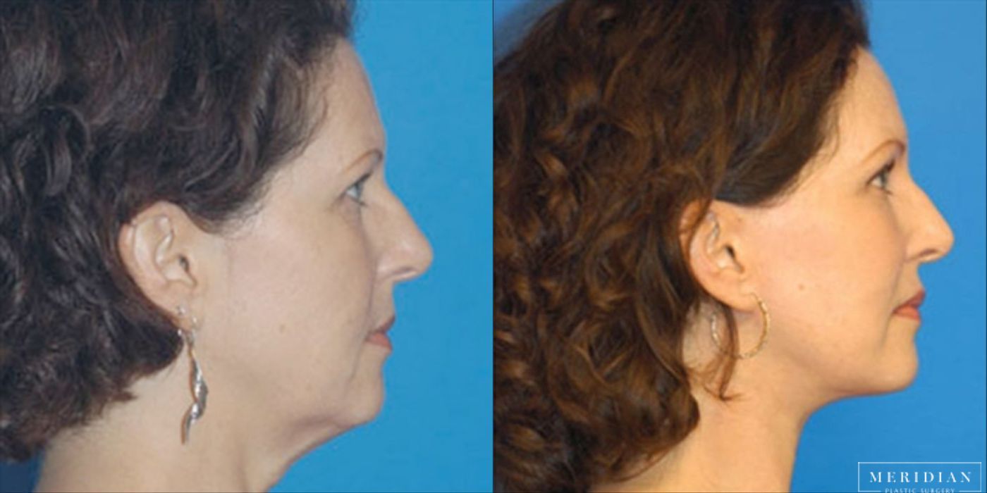 Brow Lift - Thumbnail 2