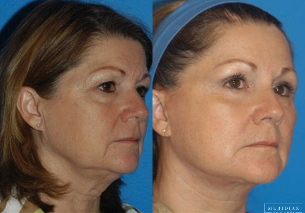 Brow Lift - Thumbnail 2