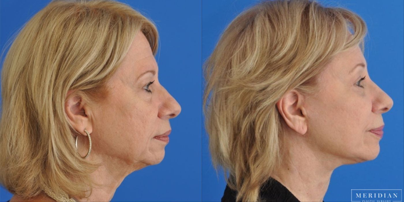 Brow Lift - Thumbnail 3