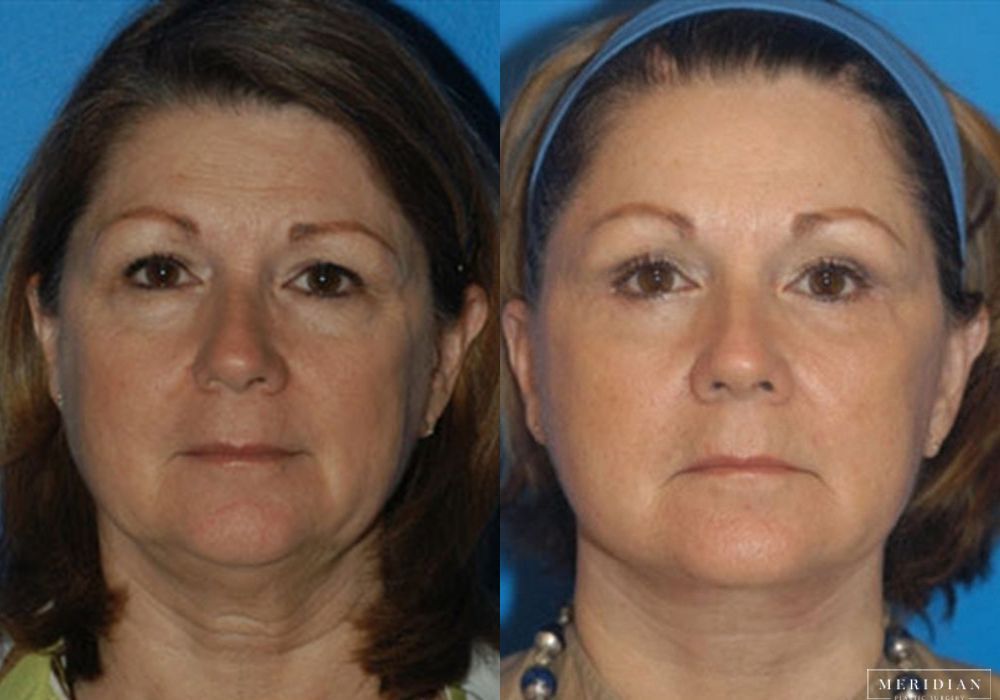 Brow Lift - Case 7909