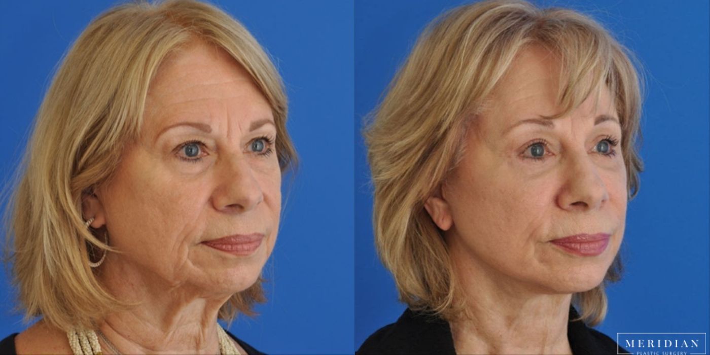 Brow Lift - Thumbnail 2