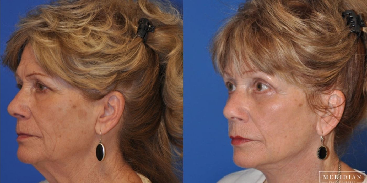 Brow Lift - Thumbnail 3