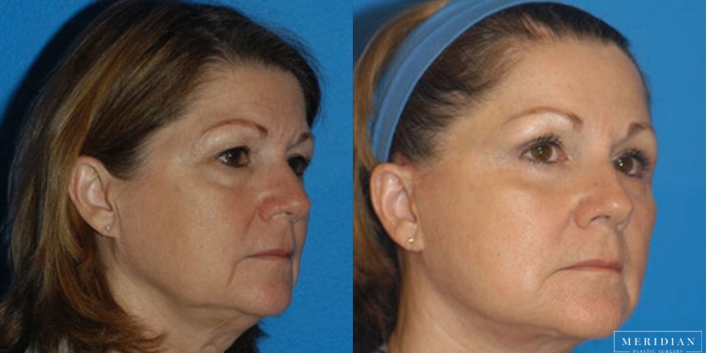 Brow Lift - Thumbnail 2