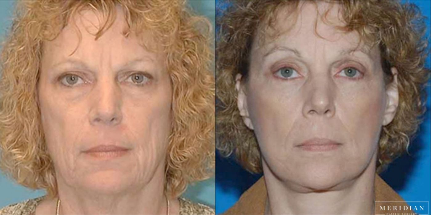 Brow Lift - Case 8591