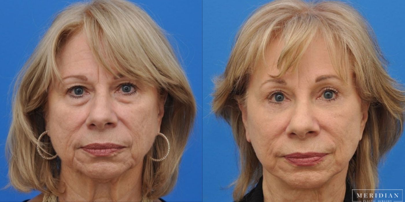 Brow Lift - Case 8595