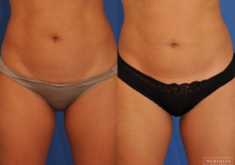 CoolSculpting® - Case 8852