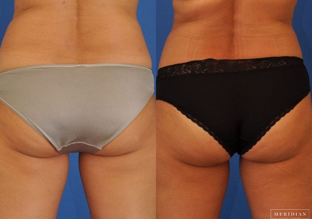 CoolSculpting® - Thumbnail 2