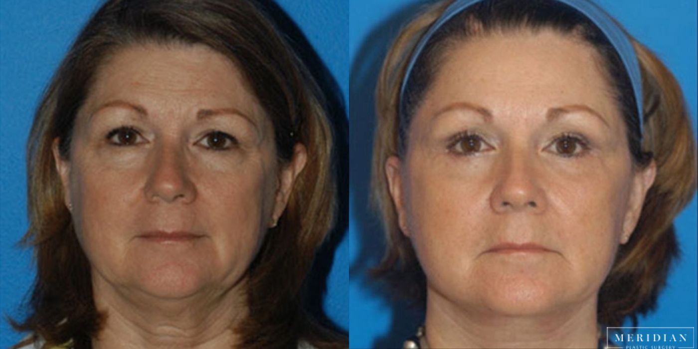 Eyelid Lift - Case 8597