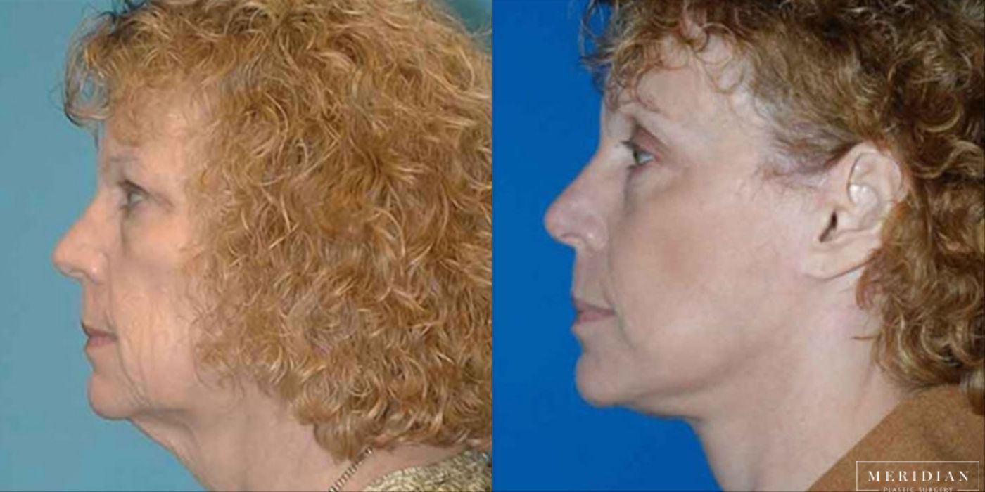 Eyelid Lift - Thumbnail 2