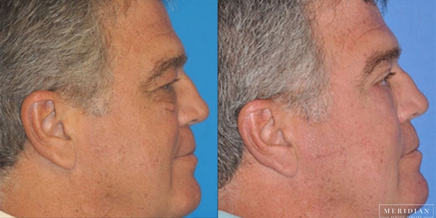 Eyelid Lift - Thumbnail 2