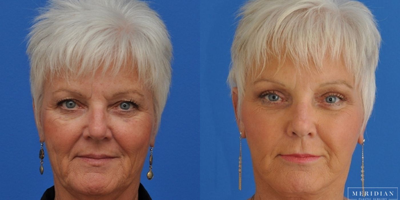 Eyelid Lift - Thumbnail 3