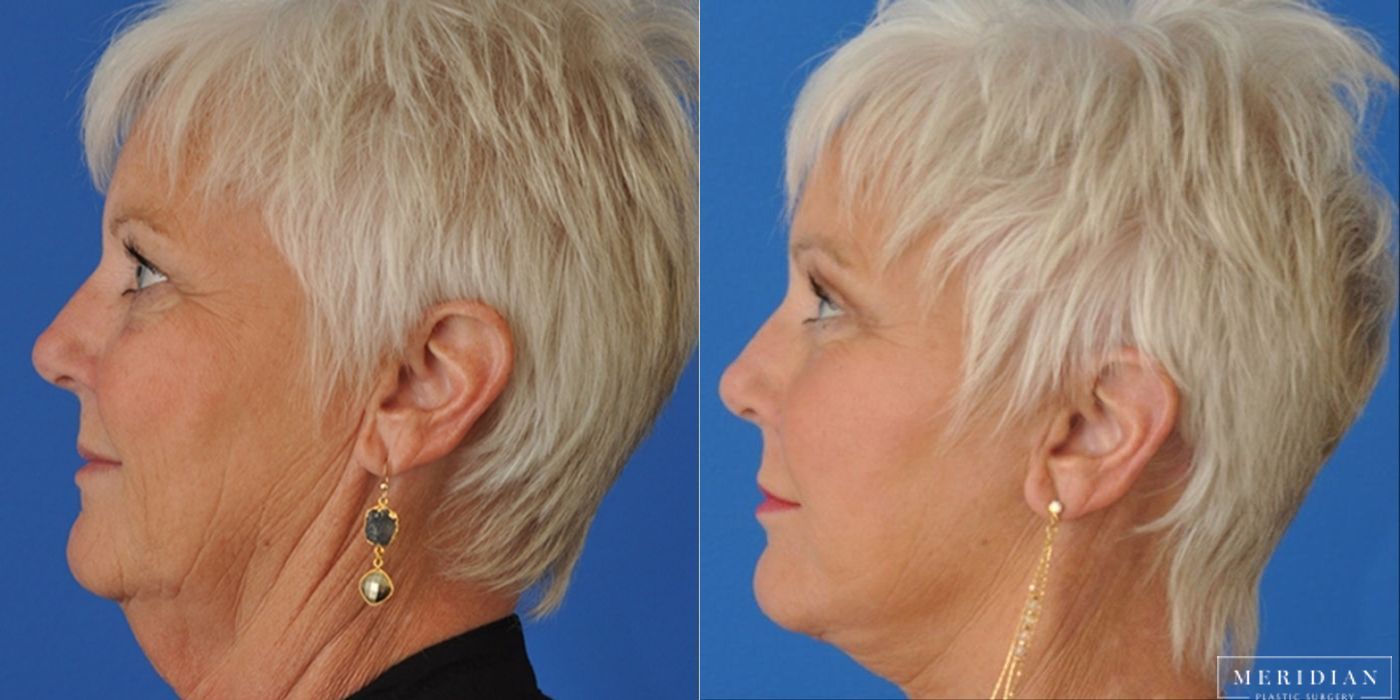 Eyelid Lift - Thumbnail 2