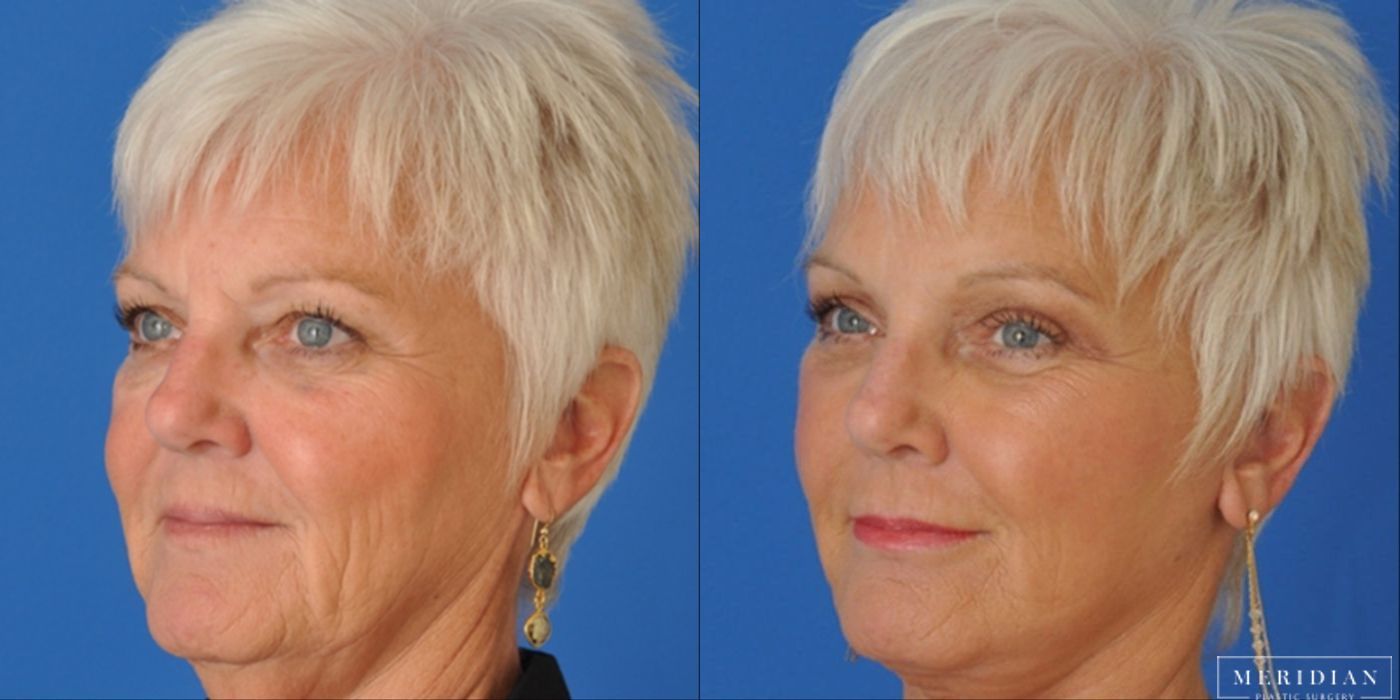 Eyelid Lift - Case 8602