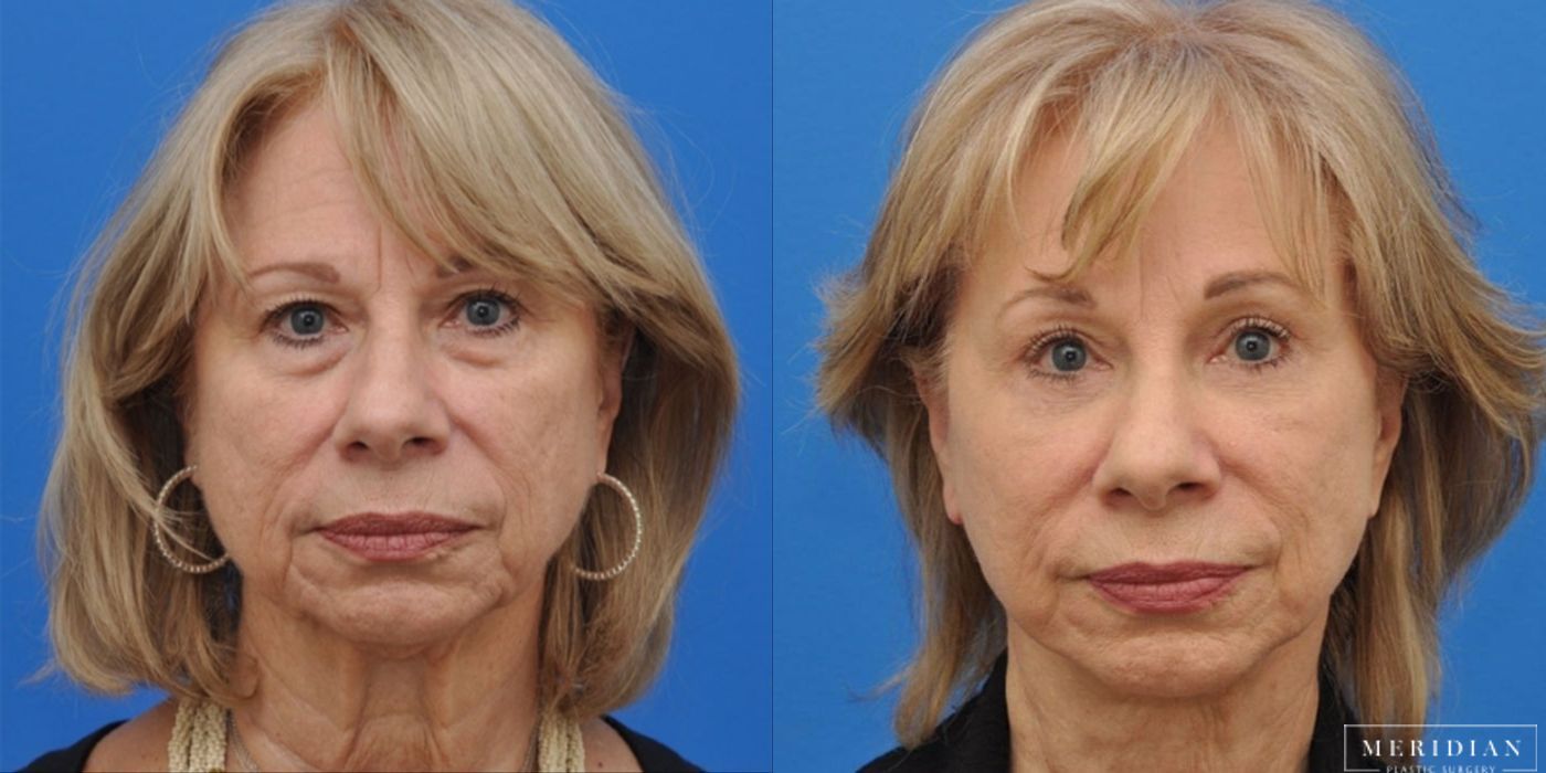 Eyelid Lift - Case 8601