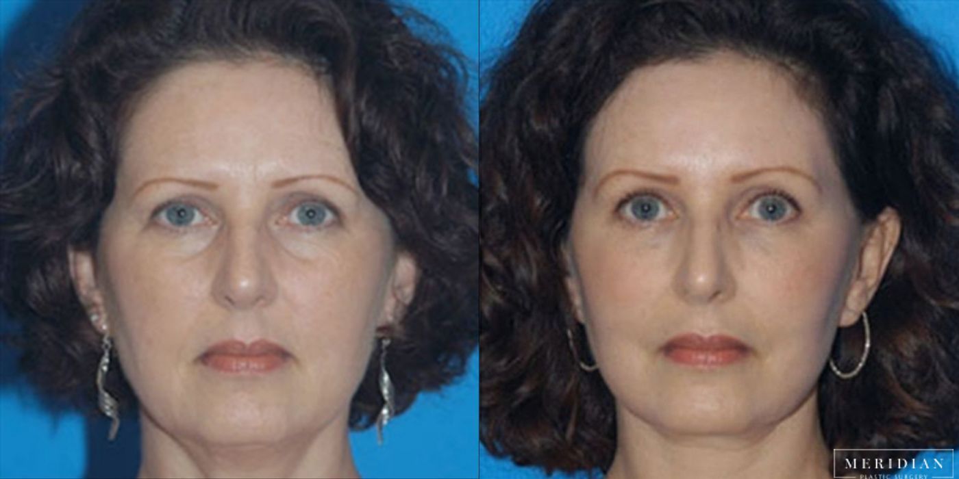 Eyelid Lift - Case 8600