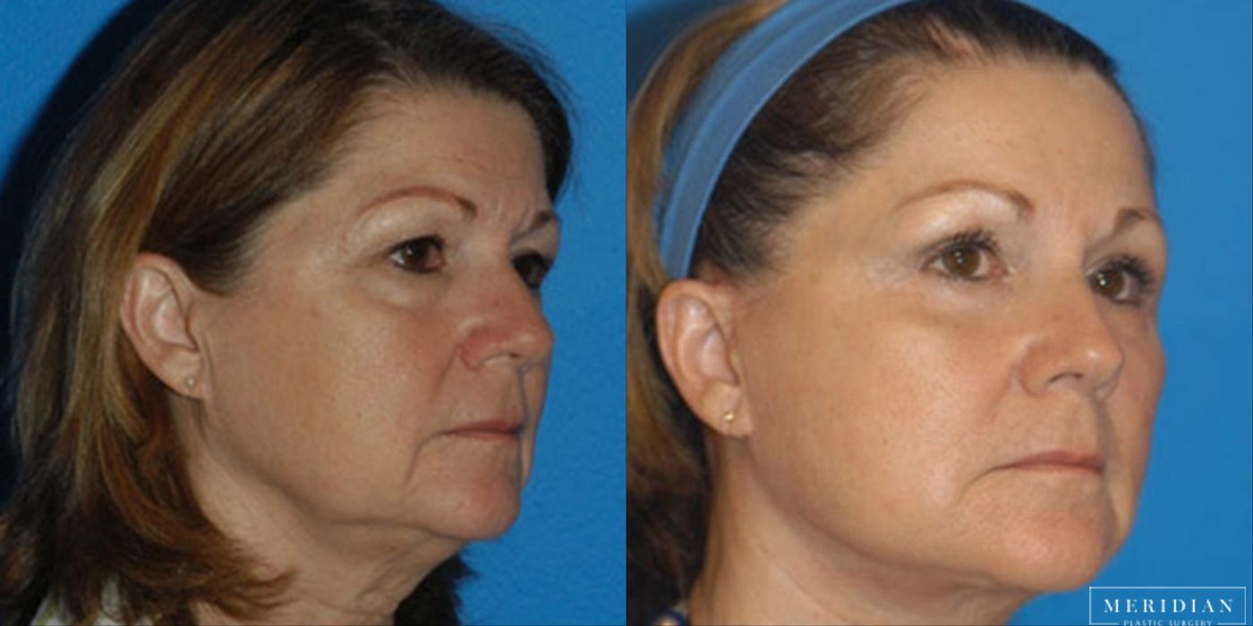 Eyelid Lift - Thumbnail 2