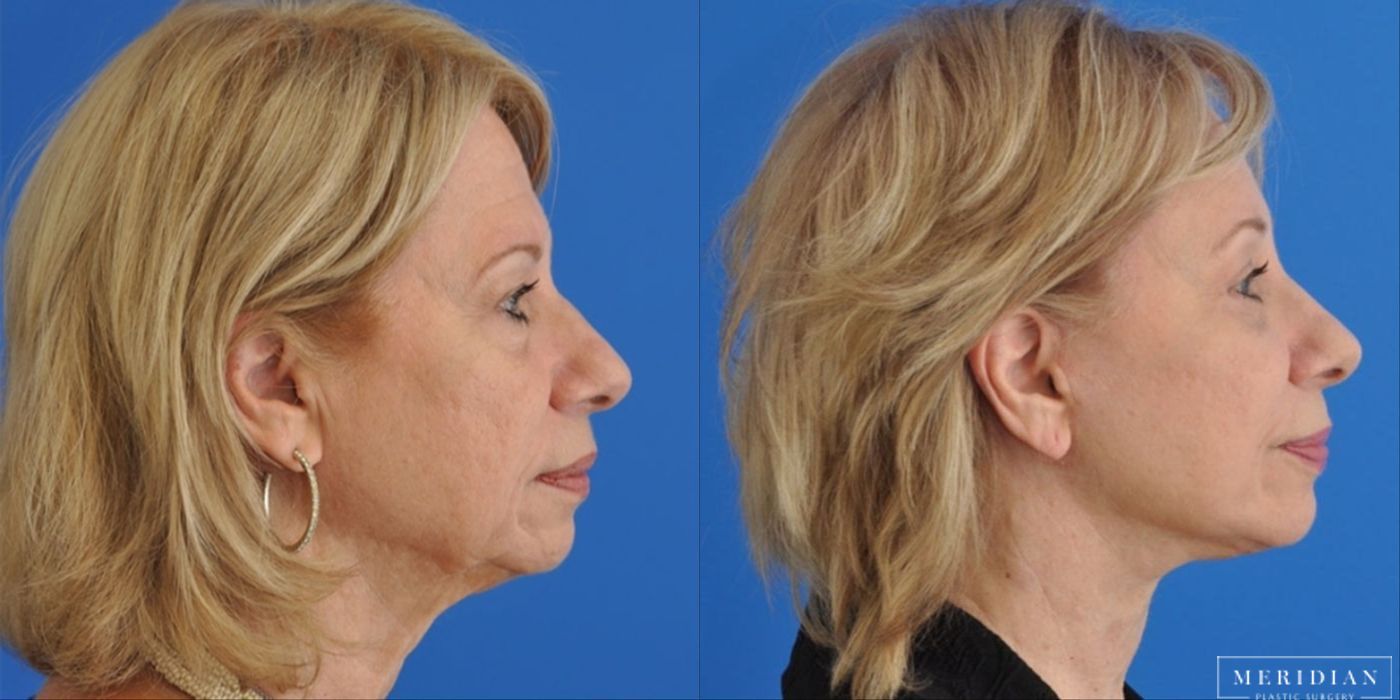 Eyelid Lift - Thumbnail 2