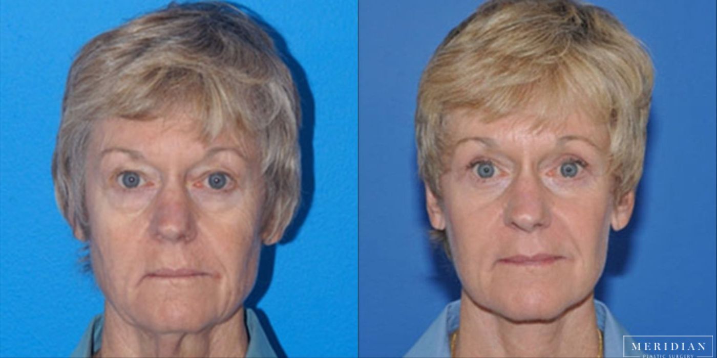 Eyelid Lift - Case 8598