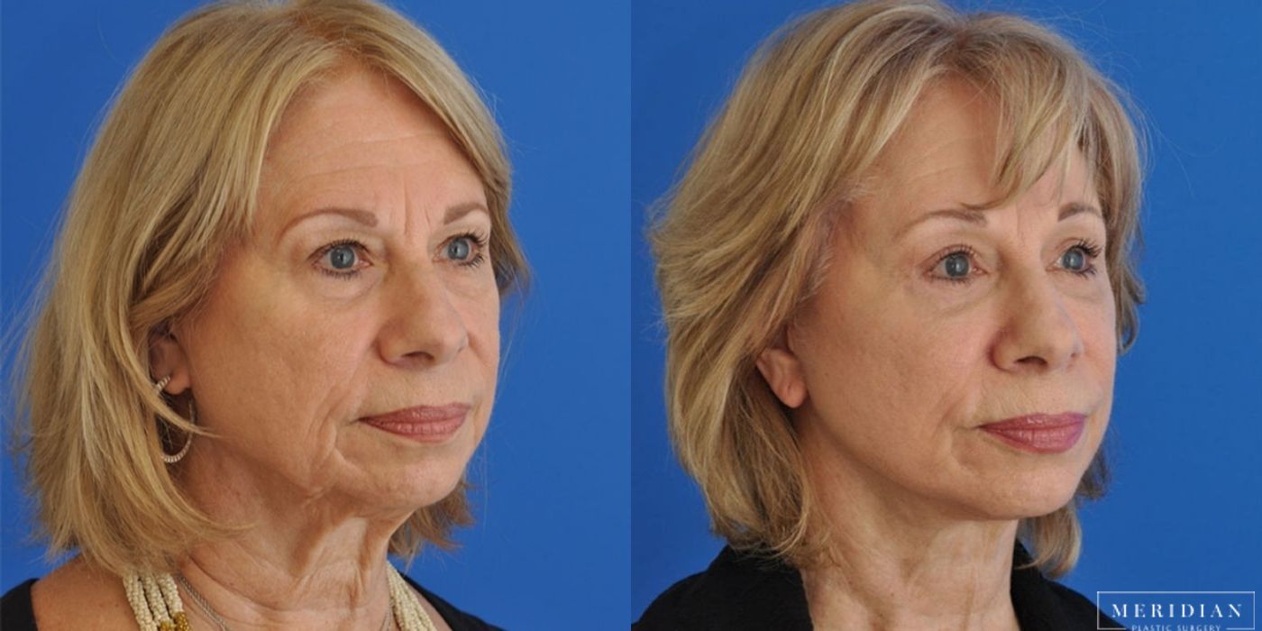 Eyelid Lift - Thumbnail 3