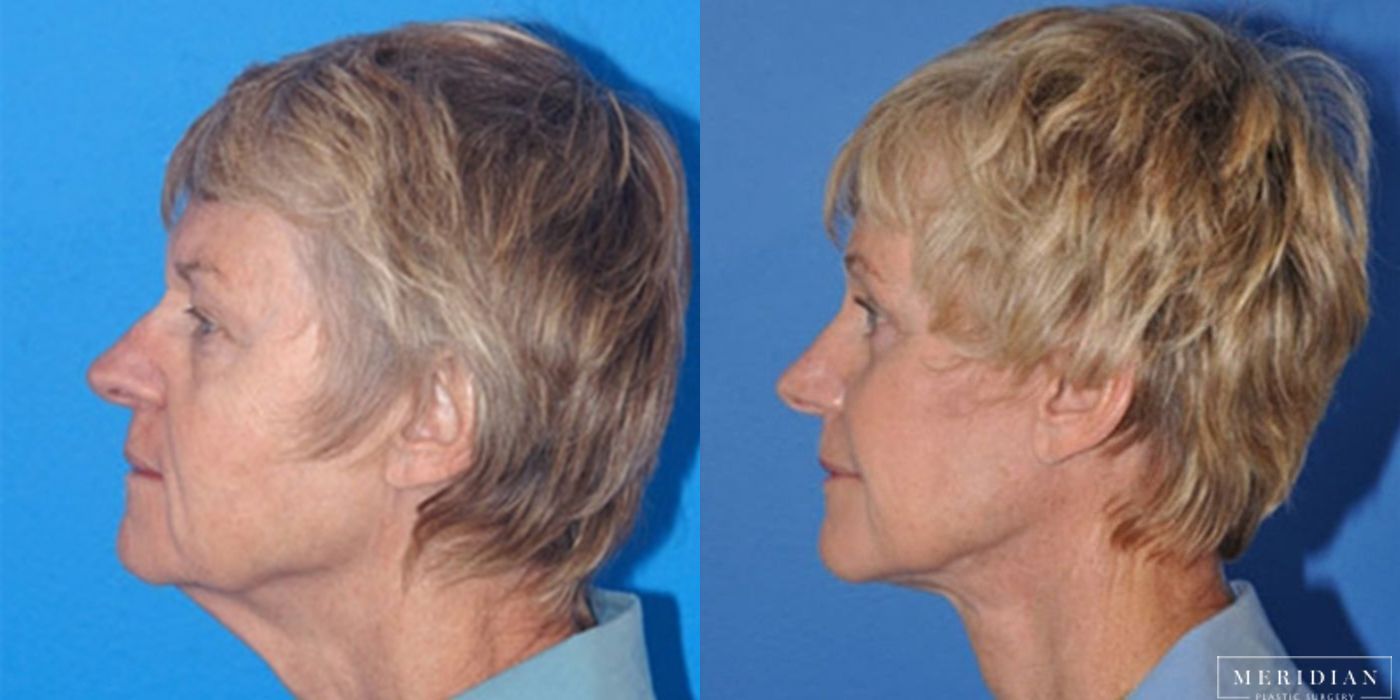 Eyelid Lift - Thumbnail 2