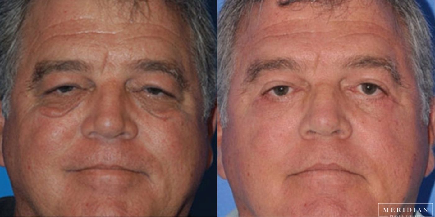 Eyelid Lift - Case 8603