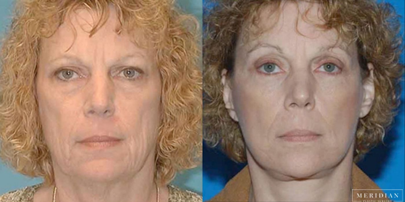 Eyelid Lift - Case 8599