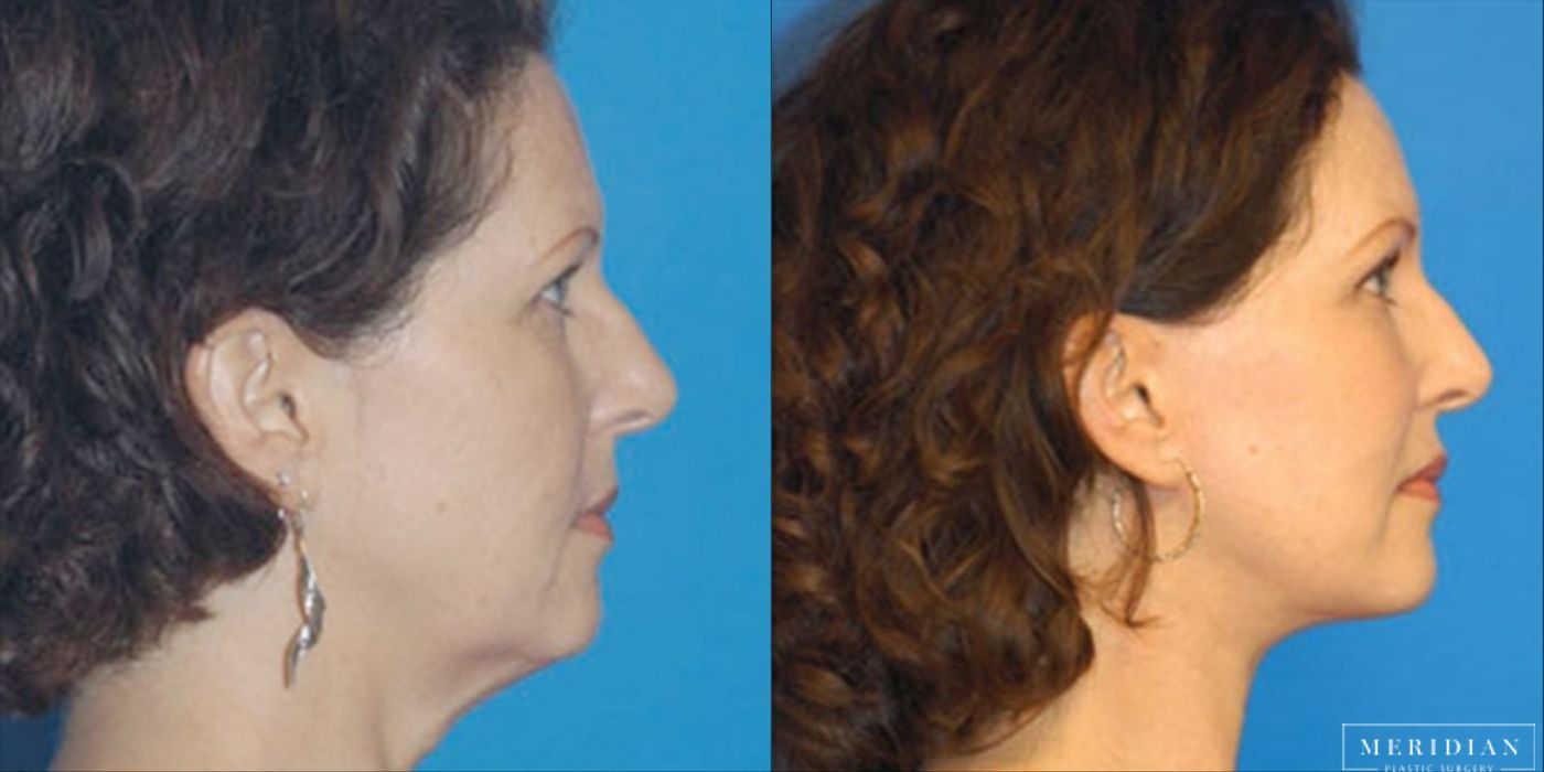 Eyelid Lift - Thumbnail 2